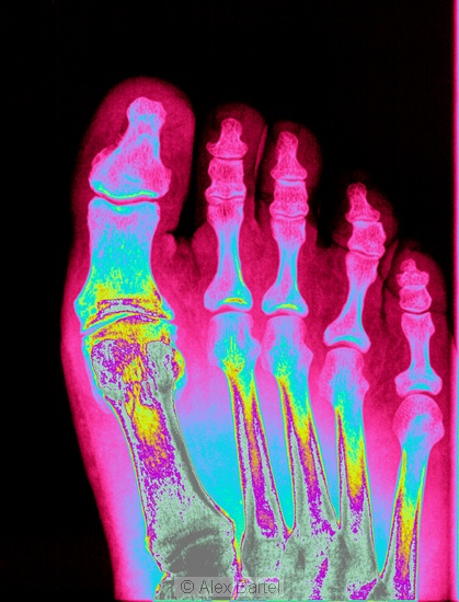 Coloured x-ray, foot