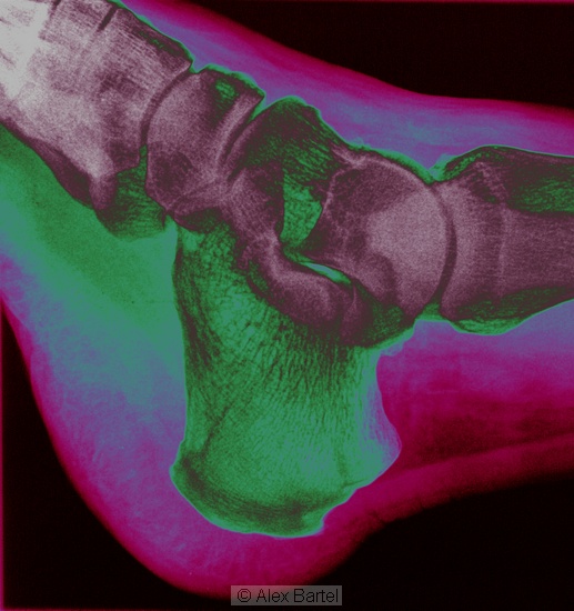 Coloured x-ray, ankle