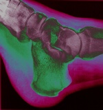 Coloured x-ray, ankle