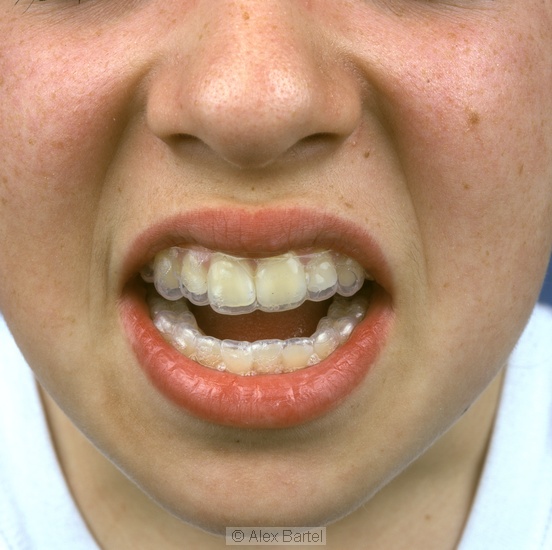 Teeth, transparent brace